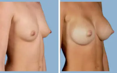 Before and After